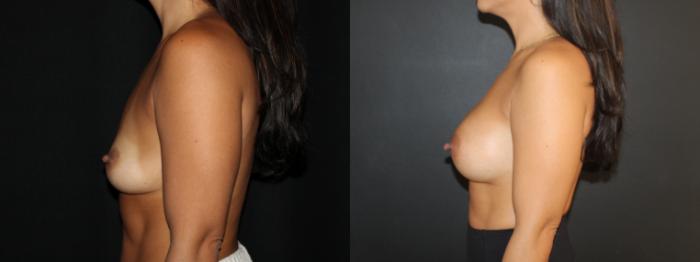 Before & After Breast Augmentation Case 96 Left Side View in Charleston, SC