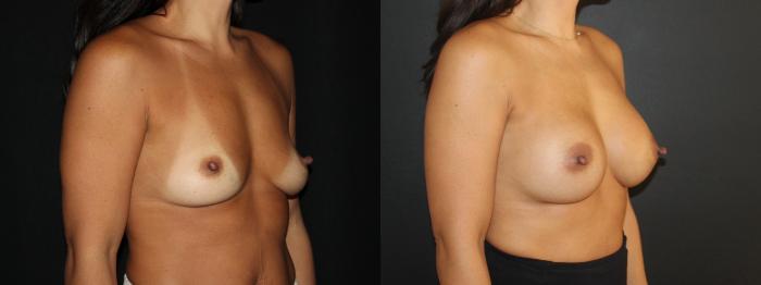Before & After Breast Augmentation Case 96 Right Oblique View in Charleston, SC