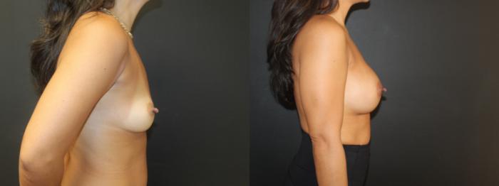 Before & After Breast Augmentation Case 96 Right Side View in Charleston, SC