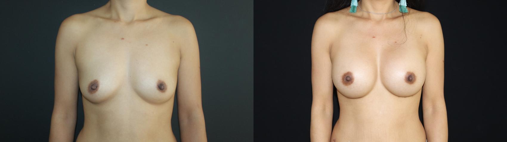 Before & After Breast Augmentation Case 97 Front View in Charleston, SC