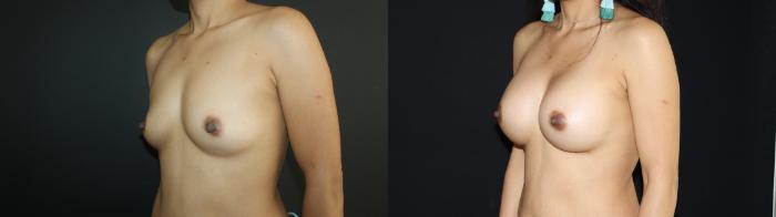 Before & After Breast Augmentation Case 97 Left Oblique View in Charleston, SC