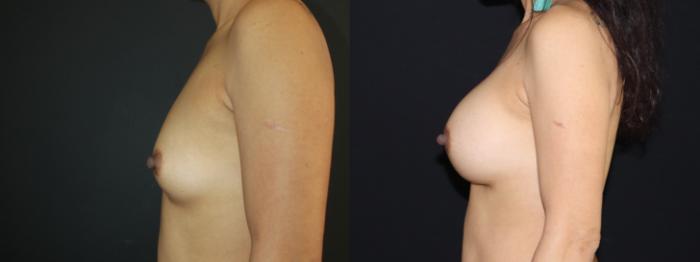 Before & After Breast Augmentation Case 97 Left Side View in Charleston, SC