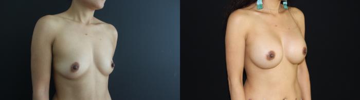 Before & After Breast Augmentation Case 97 Right Oblique View in Charleston, SC