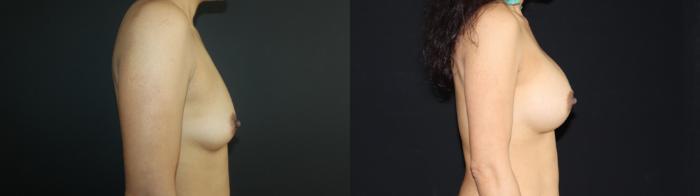 Before & After Breast Augmentation Case 97 Right Side View in Charleston, SC