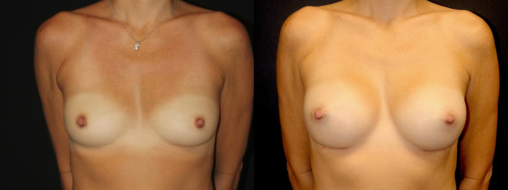 Before & After Breast Augmentation Case 98 Front View in Charleston, SC