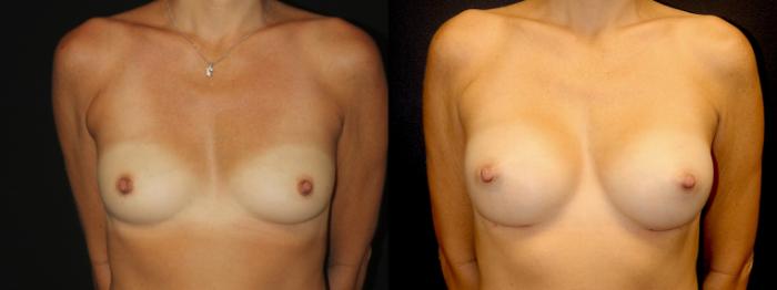 Before & After Breast Augmentation Case 98 Front View in Charleston, SC
