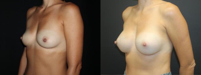 Before & After Breast Augmentation Case 98 Left Oblique View in Charleston, SC