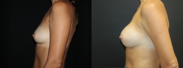 Before & After Breast Augmentation Case 98 Left Side View in Charleston, SC