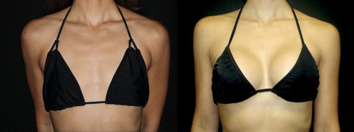 Before & After Breast Augmentation Case 99 Bikini View in Charleston, SC