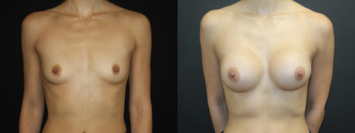 Before & After Breast Augmentation Case 99 Front View in Charleston, SC