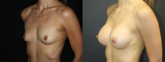 Before & After Breast Augmentation Case 99 Left Oblique View in Charleston, SC