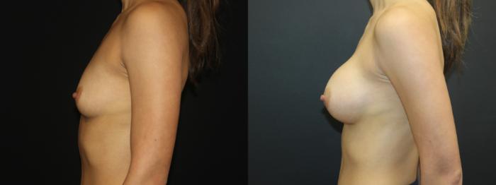 Before & After Breast Augmentation Case 99 Left Side View in Charleston, SC