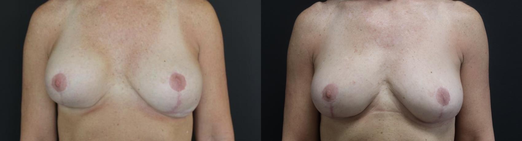 Before & After Breast Fat Transfer Case 154 Front View in Charleston, SC