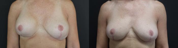 Before & After Breast Fat Transfer Case 154 Front View in Charleston, SC