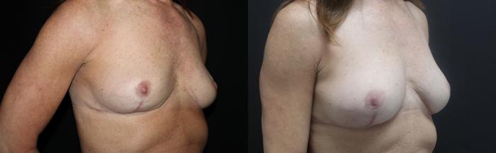 Before & After Breast Fat Transfer Case 154 Right Oblique View in Charleston, SC