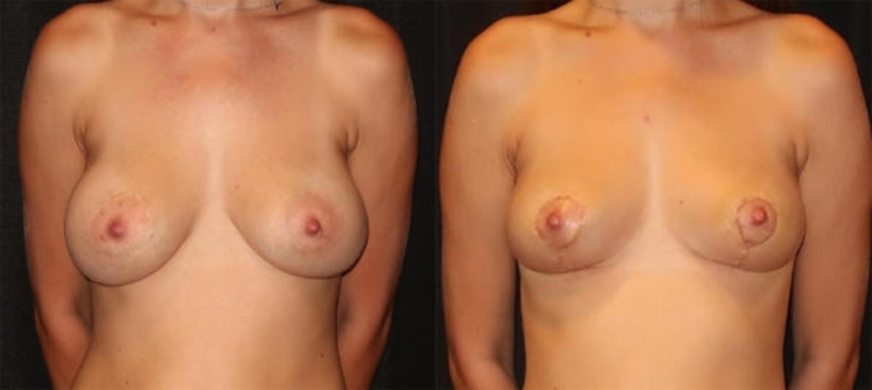 Before & After Breast Lift Case 35 Front View in Charleston, SC