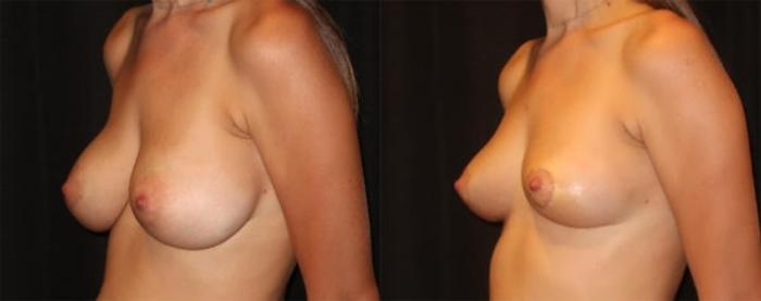 Before & After Breast Implant Removal Case 35 Left Oblique View in Charleston, SC