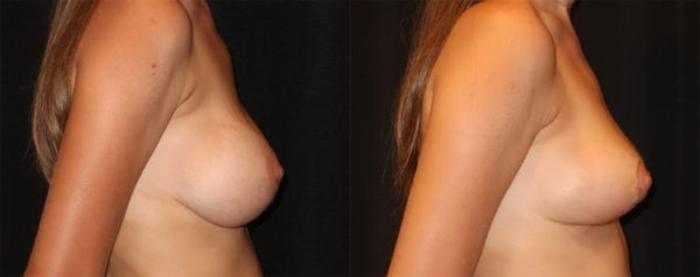 Before & After Breast Lift Case 35 Right Side View in Charleston, SC