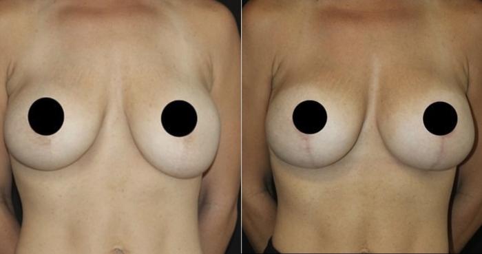 Before & After Breast Implant Exchange Case 111 Front View in Charleston, SC