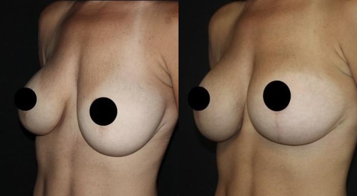 Before & After Breast Lift Case 111 Left Oblique View in Charleston, SC