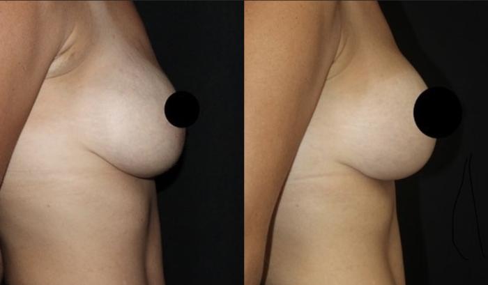 Before & After Breast Lift Case 111 Right Side View in Charleston, SC