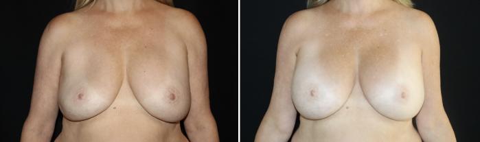 Before & After Breast Implant Exchange Case 136 Front View in Charleston, SC