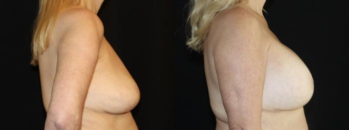 Before & After Breast Implant Exchange Case 136 Right Side View in Charleston, SC