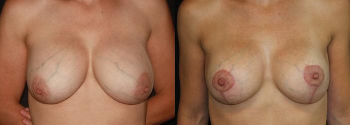 Before & After Breast Lift Case 138 Front View in Charleston, SC