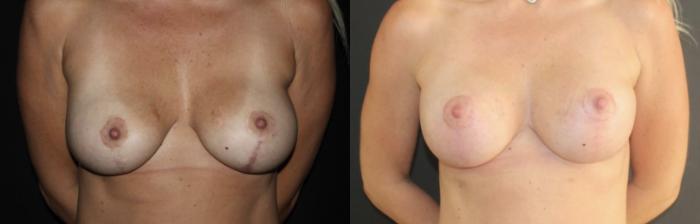 Before & After Breast Implant Exchange Case 140 Front View in Charleston, SC