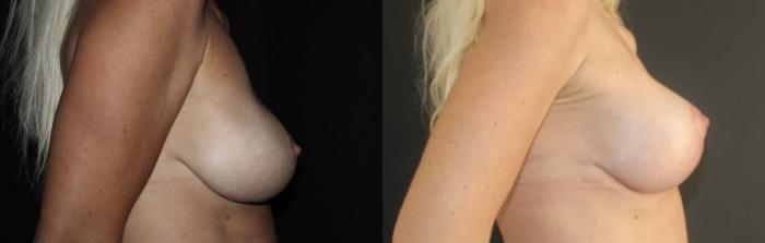 Before & After Breast Implant Exchange Case 140 Right Side View in Charleston, SC