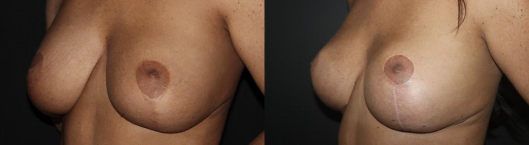 Before & After Breast Lift Case 141 Left Oblique View in Charleston, SC