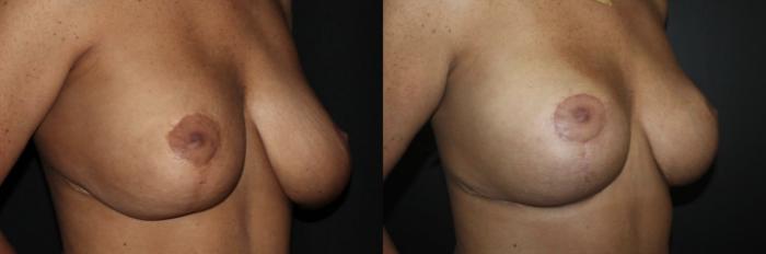 Before & After Breast Lift Case 141 Right Oblique View in Charleston, SC