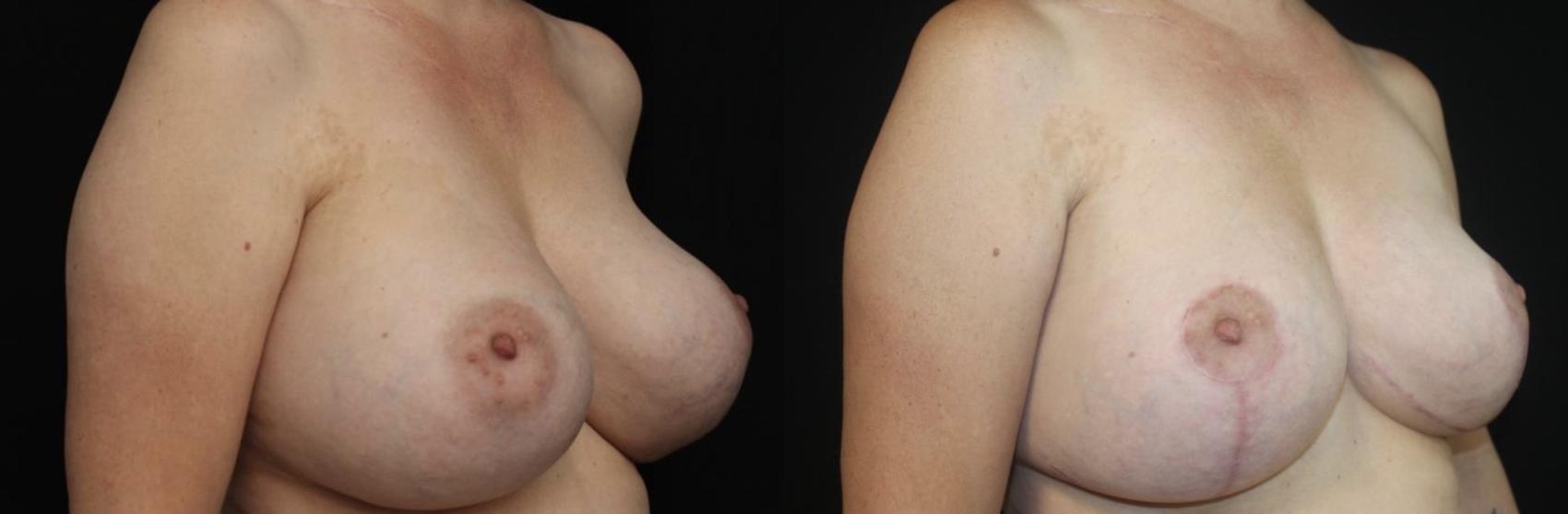 Before & After Breast Lift Case 142 Right Oblique View in Charleston, SC