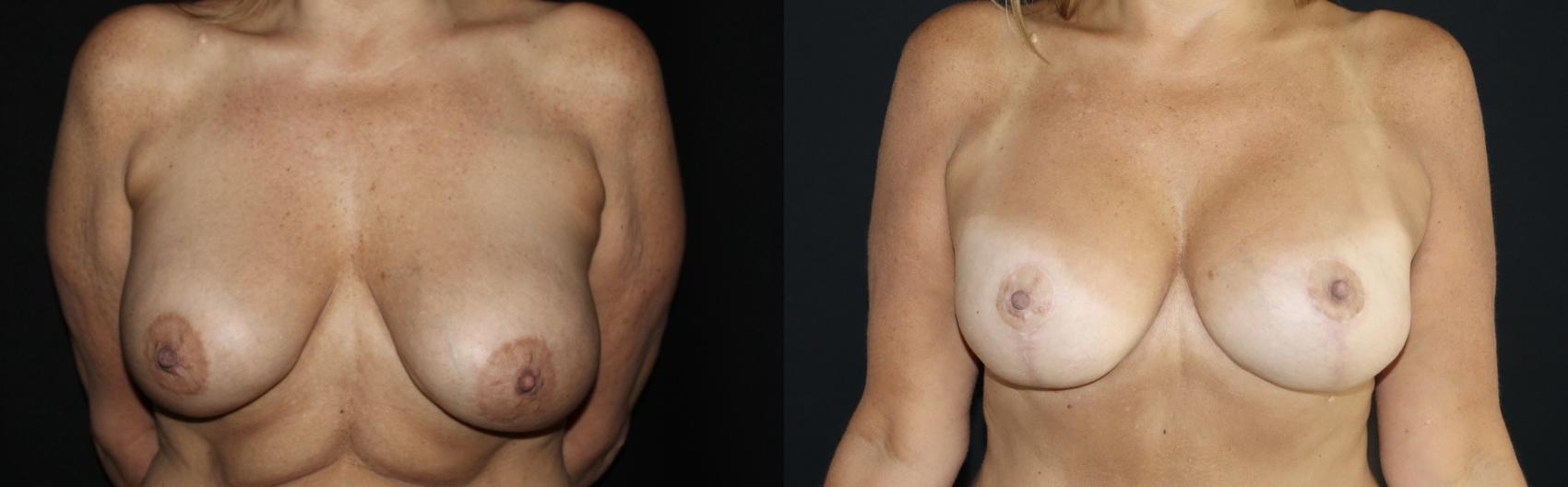 Before & After Breast Implant Exchange Case 151 Front View in Charleston, SC