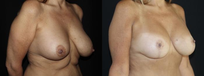 Before & After Mommy Makeover Case 151 Right Oblique View in Charleston, SC