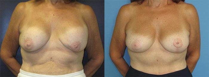 Before & After Breast Implant Exchange Case 29 Front View in Charleston, SC