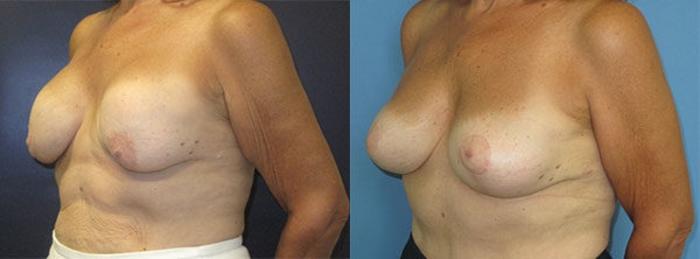 Before & After Breast Implant Exchange Case 29 Left Oblique View in Charleston, SC