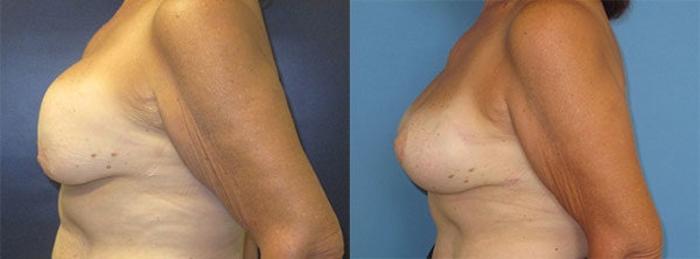 Before & After Breast Implant Exchange Case 29 Left Side View in Charleston, SC