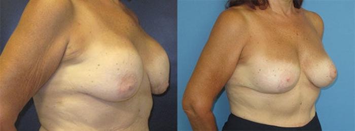 Before & After Breast Implant Exchange Case 29 Right Oblique View in Charleston, SC