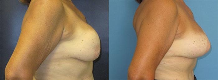 Before & After Breast Implant Exchange Case 29 Right Side View in Charleston, SC