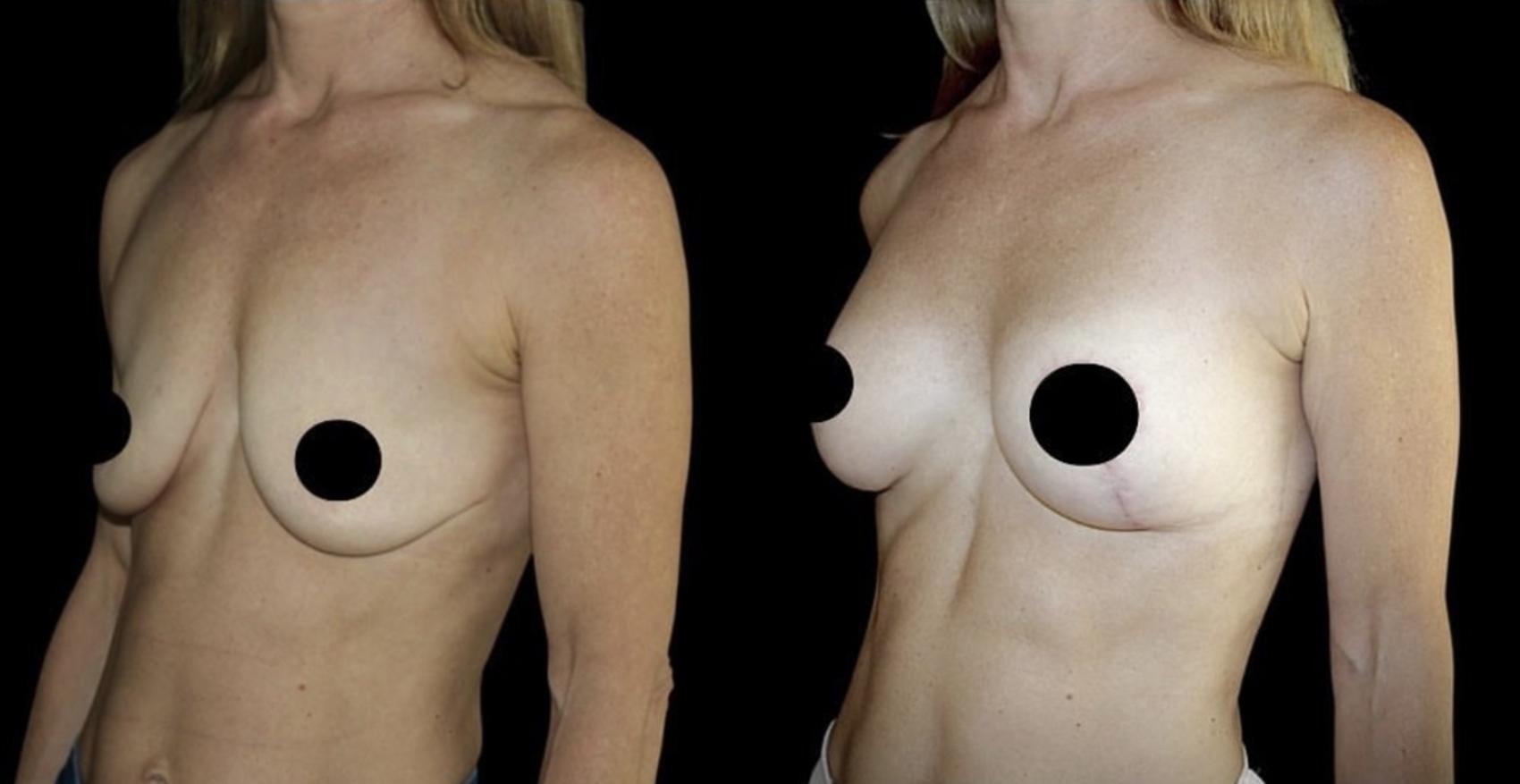 Before & After Breast Lift Case 110 Left Oblique View in Charleston, SC
