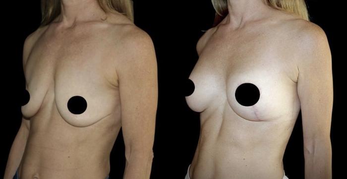 Before & After Breast Lift Case 110 Left Oblique View in Charleston, SC
