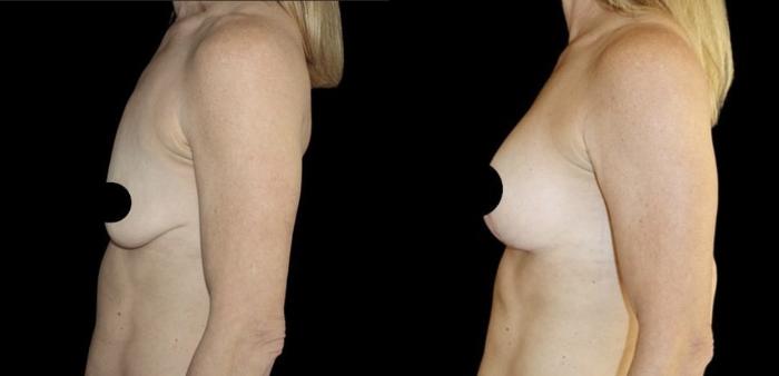 Before & After Breast Lift Case 110 Left Side View in Charleston, SC