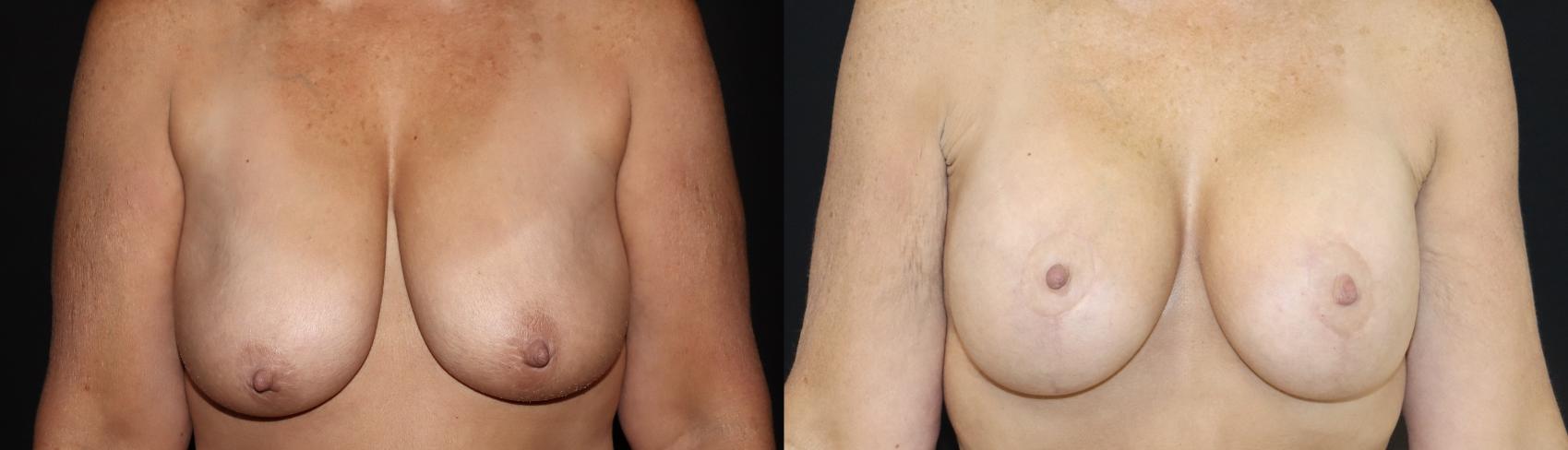 Before & After Breast Lift Case 147 Front View in Charleston, SC