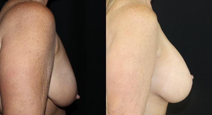 Before & After Breast Lift Case 147 Right Side View in Charleston, SC