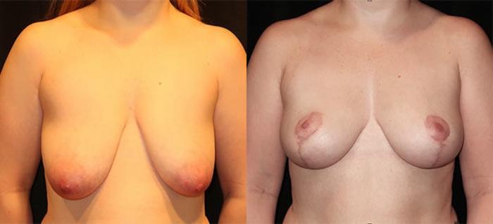 Before & After Breast Lift Case 18 Front View in Charleston, SC