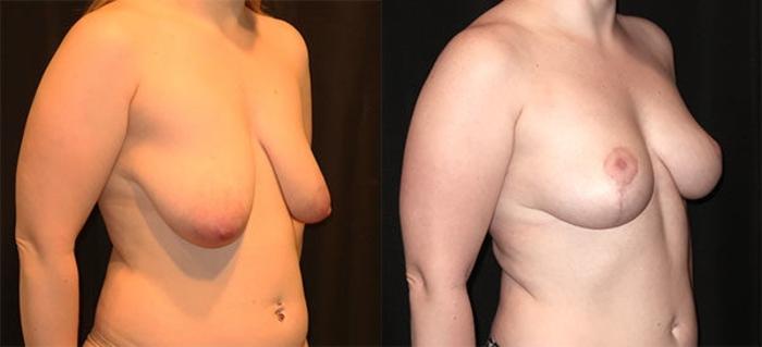 Before & After Breast Lift Case 18 Right Oblique View in Charleston, SC