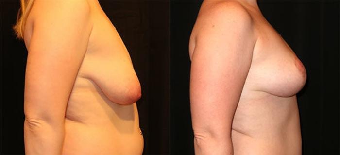 Before & After Breast Lift Case 18 Right Side View in Charleston, SC