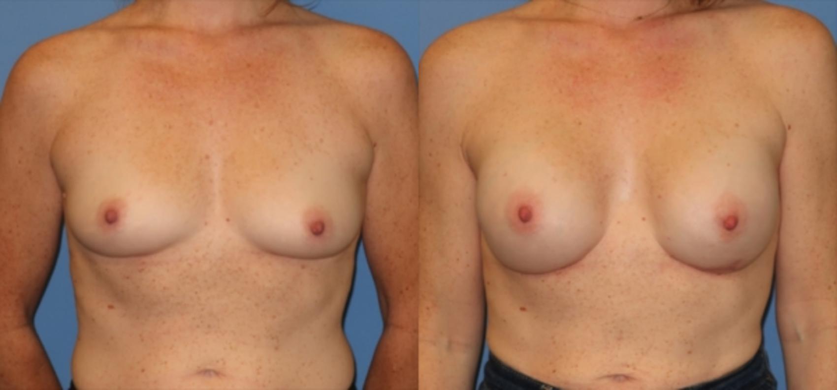 Before & After Breast Reconstruction Case 19 Front View in Charleston, SC