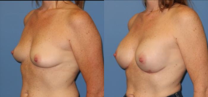 Before & After Breast Reconstruction Case 19 Left Oblique View in Charleston, SC
